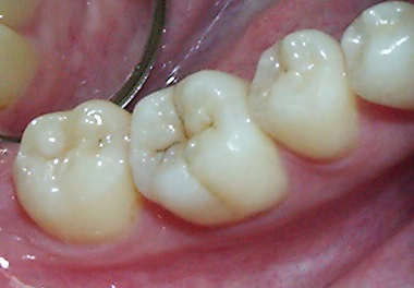 むし歯3