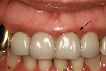 不適合な金属冠による歯槽膿漏症
