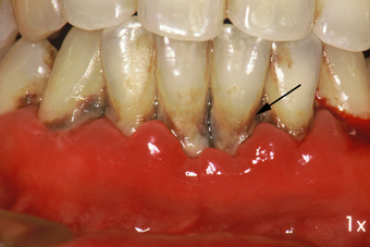 歯槽膿漏症1