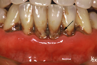 歯槽膿漏症2