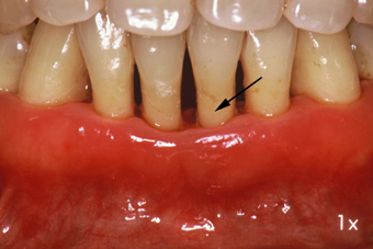 歯槽膿漏症3