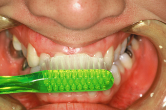 歯ブラシの方法